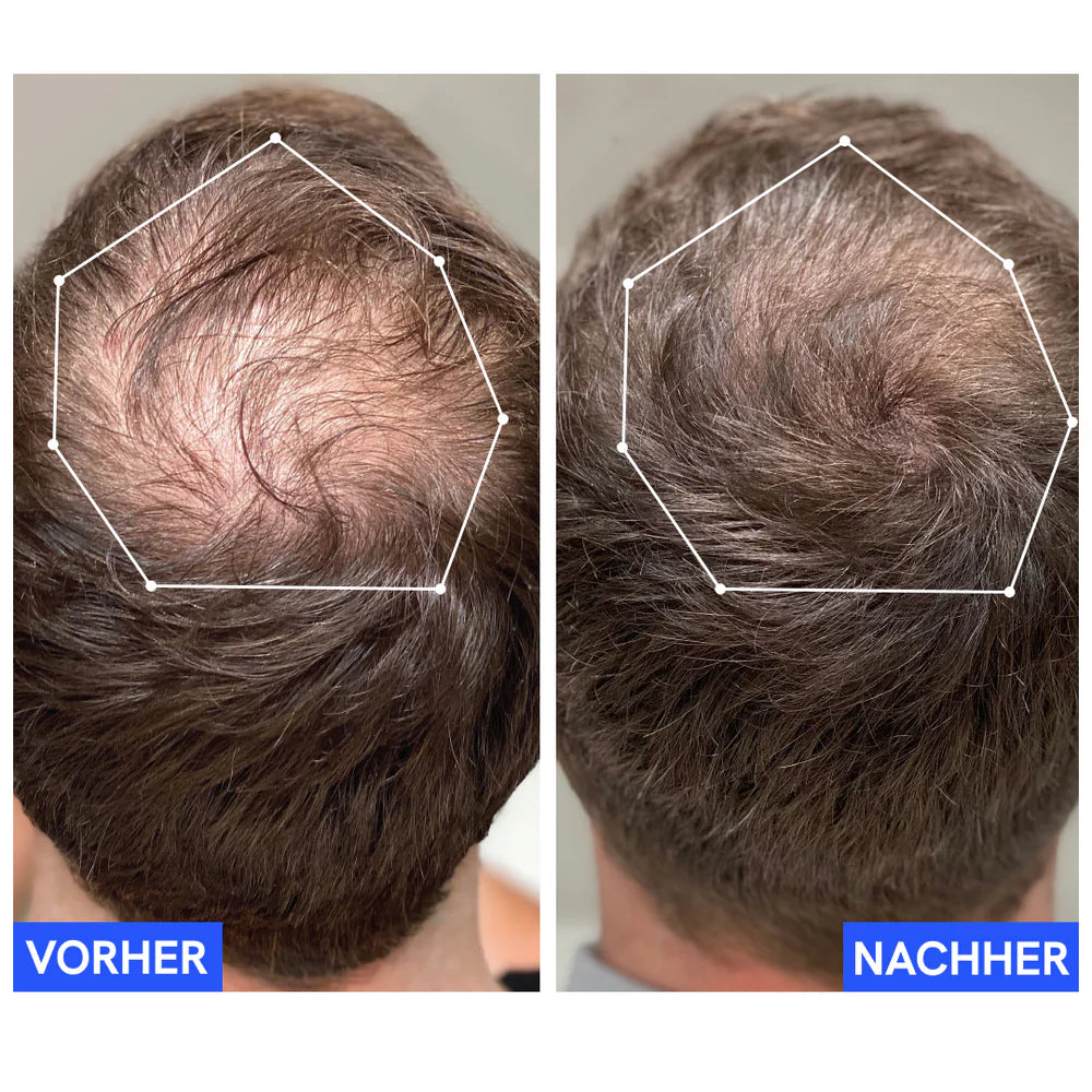 Bayor 2.0 - Das Wunder des Haarwuchses