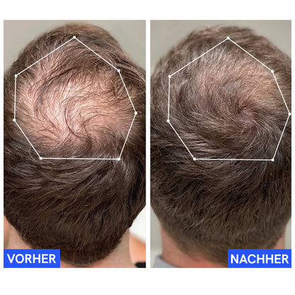 Bayor 2.0 - Das Wunder des Haarwuchses